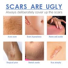 scars silicone scar plasters