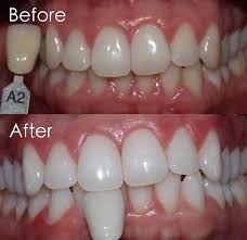 Thinking About Having Your Teeth Whitened Centre For