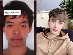 young man undergoes plastic surgery