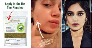 how to get rid of pimples overnight