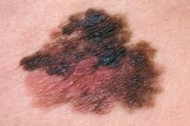 Left untreated, melanoma can kill you. Skin Cancer Melanoma Overview Hse Ie