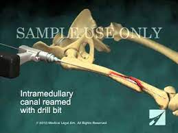 intramedullary nailing of right femur