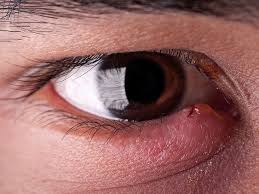 how long does a stye last duration and