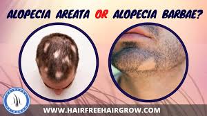 alopecia areata or alopecia barbae
