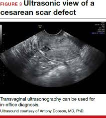 cesarean scar defect what is it and