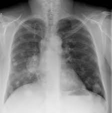 Pulmonary Metastases Radiology