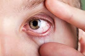 pale eye mucosa is it due to anemia