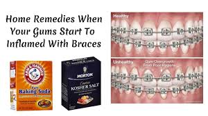 gums start to inflamed with braces