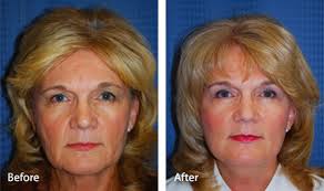 What's it like to go from being unattractive to gorgeous? Facelift Before And After Photos