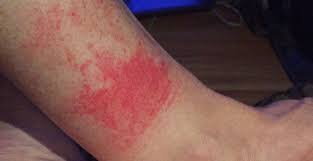 disney rash what it is how to treat