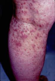 The rash may first appear on your legs, arms, or buttocks. Purpuric Rash An Overview Sciencedirect Topics