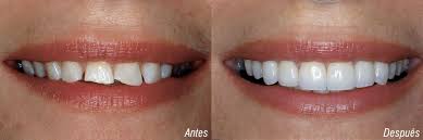 Resultado de imagen de dientes rotos antes y despues