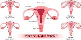 If you want to maintain or enhance libido after hysterectomy, it will do good to play an active part during sexual intercourse. Hysterectomy National Women S Health Network