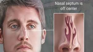 Doctors call surgery to straighten the septum septoplasty. it's usually done by an ear, nose, and throat specialist. What Is Deviated Septum Surgery Ask The Ent Capital Otolaryngology
