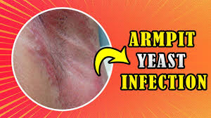 armpit rashes causes treatment and