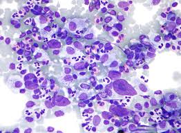 It develops in lymphocytes, which are a type of white blood cell. Hodgkin Lymphoma Wikipedia