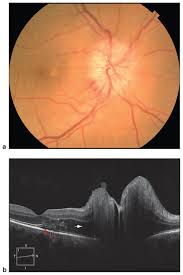 Ischemic optic neuropathy is the most common optic nerve disorder in patients over age 50 years. Nonarteritic Anterior Ischemic Optic Neuropathy Naion American Academy Of Ophthalmology