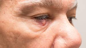 eye stye causes symptoms treatments