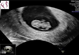 Ssw sehr gut im ultraschall sichtbar. 9 Ssw Ultraschall Forum Fur Februar 2021 Mamis