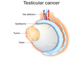 testicular cancer aaurology