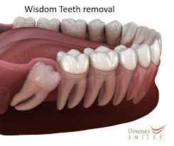 wisdom teeth removal surgery for