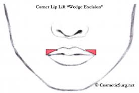 lip lift upper lip lift corner lip