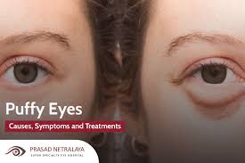 symptoms and treatments for puffy eyes