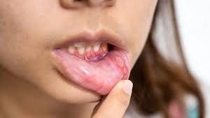 cure mouth ulcers fast and naturally