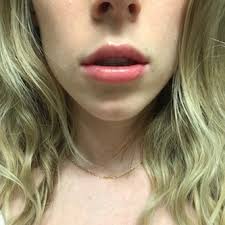 exactly what to expect from lip fillers