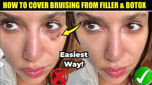 how to cover bruising from fillers and