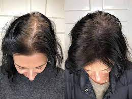 monistat for hair growth have you