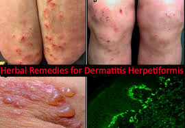 dermais herpetiformis skin disorder