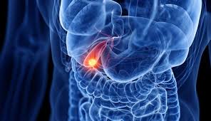 Gallbladder cancer: 9 facts about symptoms, diagnosis and treatment | MD Anderson Cancer Center
