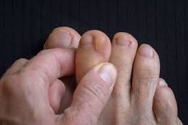 blisters on toes causes and treatments