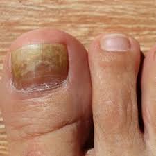 nail fungus middle tennessee foot