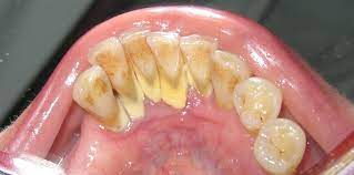 remove dental plaque and tartar