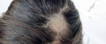 Saçkıran(Alopesi areata) nedir? Saçkıran belirtileri ve tedavi yöntemleri  nelerdir?