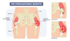 Image result for icd 10 code for greater trochanteric bursitis right hip