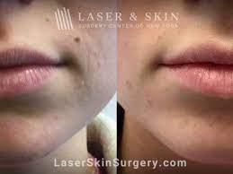 dermal filler injections new york ny