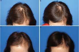 Product reviews, product recommendations, expert tips, top picks Stem Cell Therapy For Hair Loss Irvine Oc Hair Restoration