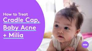 baby acne how to identify and treat