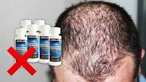it does not prevent hair loss