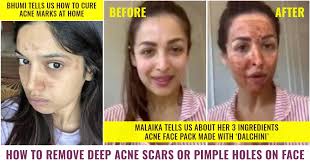 remove deep acne scars or pimple holes