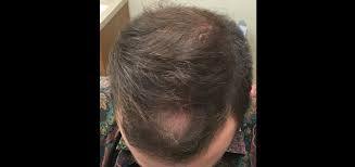 Get to the root of the problem. Keralase Treatment For Hair Loss Advanced Dermatology
