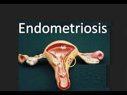 Meaning of endometriosis in english. Endometriosis Youtube