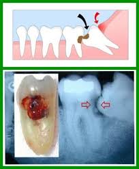 How to remove cavity from teeth at home? Dentaltown Where The Dental Community Lives Cirurgia Bucal Escola De Higiene Dental Humor Dental
