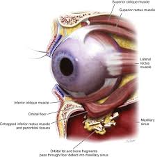 orbital fractures pocket dentistry