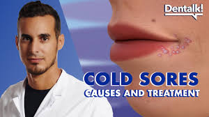 herpes virus on lips