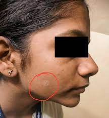 white spots on the face in children