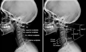 cervical lordosis the effect of age